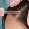 Advanced hair restoration in Saraland AL