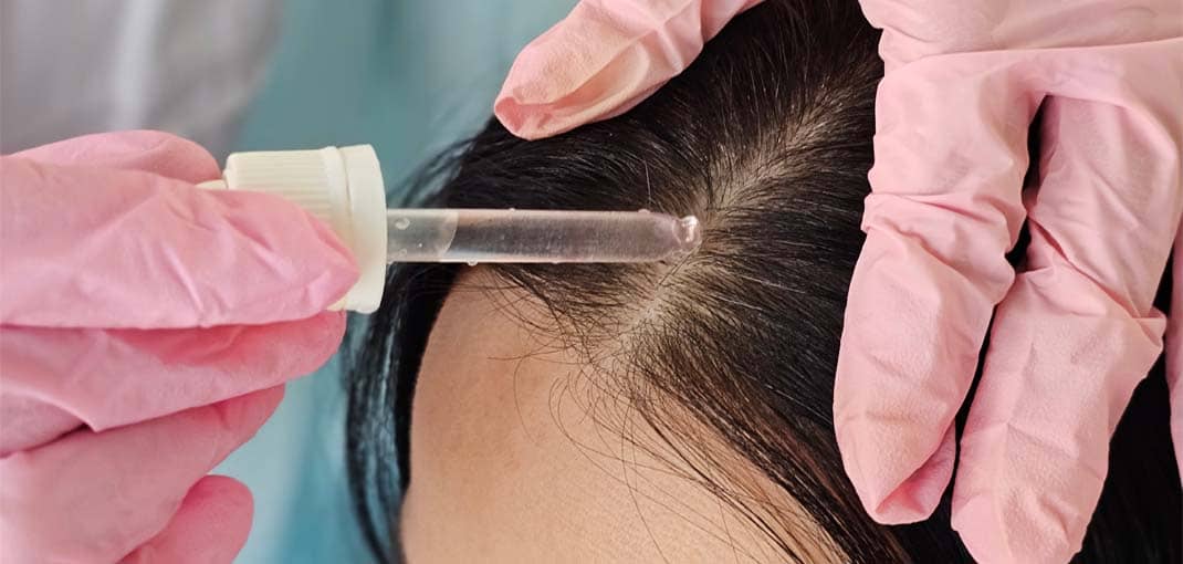 Advanced hair restoration in Saraland AL